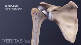 Reverse Shoulder Replacement Risks and Complications | Arthritis-health