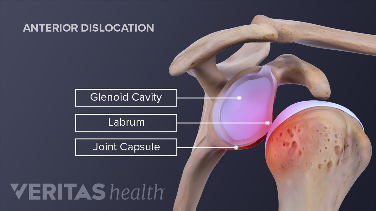 Glenohumeral Joint Dislocation