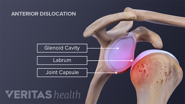 Anterior view of a dislocated shoulder labeling the joint capsule, glenoid, and labrum.