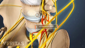 Vista anterior de la pelvis marcando una hernia de disco lumbar