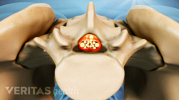 Médula espinal comprimida debido al estrechamiento del canal central.