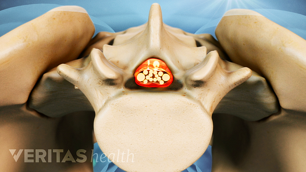 An illustration showing lumbar vertebra with the central canal highlighted in red.