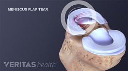 Flap tear in the knee meniscus
