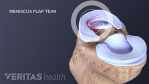 A flap tear is one type of meniscus tear
