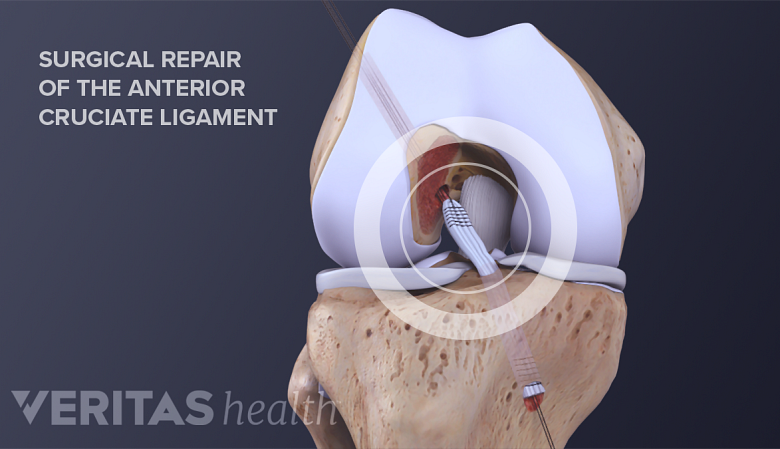 ACL Tear Recovery: Surgery & Treatment Options