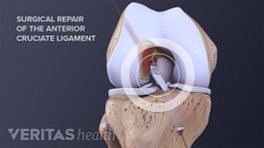 Patellar tendon graft placed during ACL repair surgery