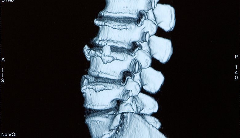 Xray of the lower spine in a side view.