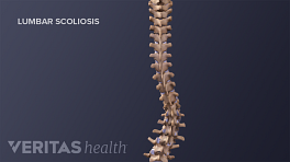 Medical illustration showing the lumbar scoliosis curve in an adult spine