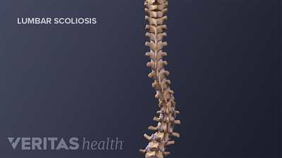 Medical illustration showing the lumbar scoliosis curve in an adult spine