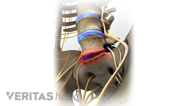 Anterior view of degenerative disc disease in the lumbar spine.