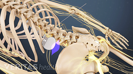 Should You Consider Spinal Cord Stimulation for Chronic Back and Neck Pain?:  Apollo Pain Management: Interventional Pain Management Specialists