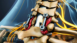Illustration of a spinal fusion surgery