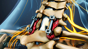 Posterior view of fusion screws in the cervical spine.