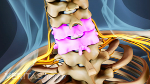 Medical illustration of the cervical spine. C5 and C6 are highlighted.