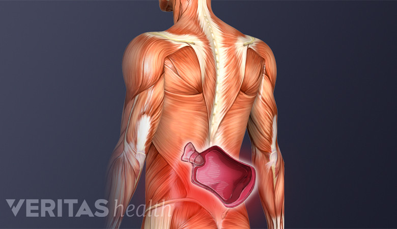 Illustrations howing posterior view of torso with a heat pack icon in the lower back.