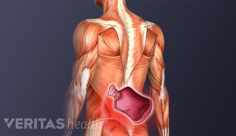 Illlustration showing posterior view of back muscles with a red highlight and an heat pack icon in the lower back.