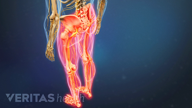An illustration showing numbness and weakness in both legs.