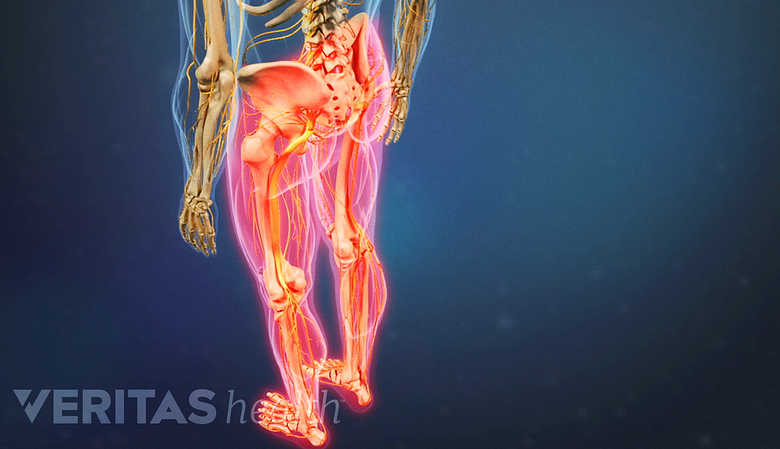 Medical illustration of lower limbs highlighted in red.