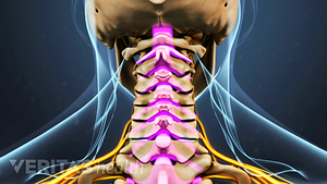 Vista posterior de la columna cervical que muestra estenosis espinal.