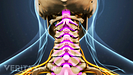Vista posterior de la columna cervical que muestra estenosis espinal.