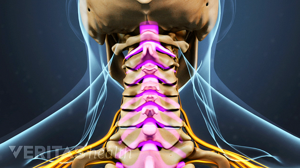 Posterior view of the cervical spine with spinal stenosis.