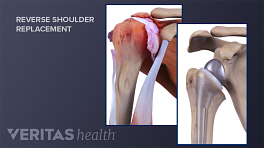 Types of Shoulder Replacement Surgeries | Arthritis-health