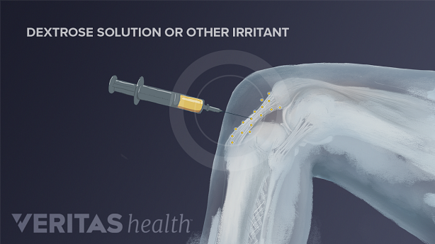 Illustration prolotherapy injection in the knee
