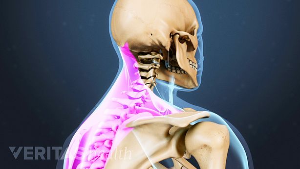Illustration of upper spine with the trapezius shoulder muscles highlighted in purple