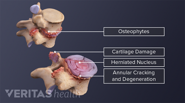 Degeneración vertebral y discal en la columna vertebral.