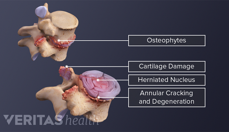 Illustration of vertebral and disc degeneration in the spine.