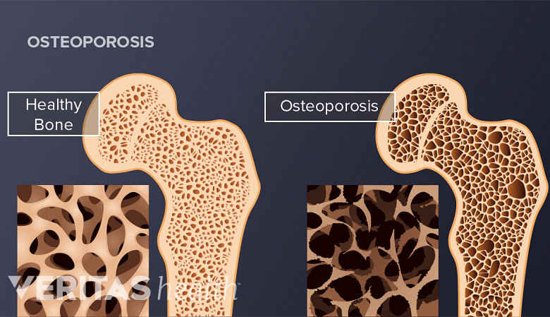 Saggital section of bone showing density of a healthy and osteoporrotic bone.