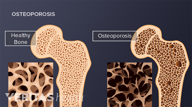 Illustration showing healthy bone and osteoporrotic bone.