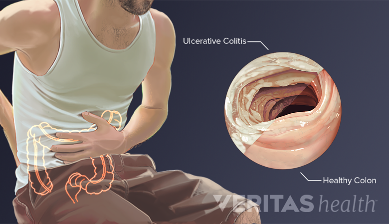 Illustration showing a man grabbing his stomach in pain, and an inset with of a colon showing signs of ulcerative colitis