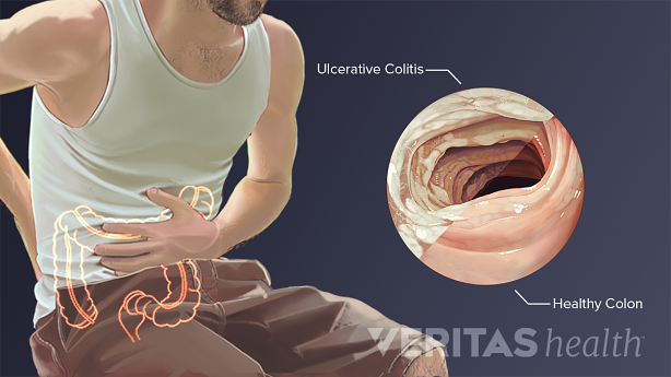 Illustration showing a man grabbing his stomach in pain, and an inset with of a colon showing signs of ulcerative colitis