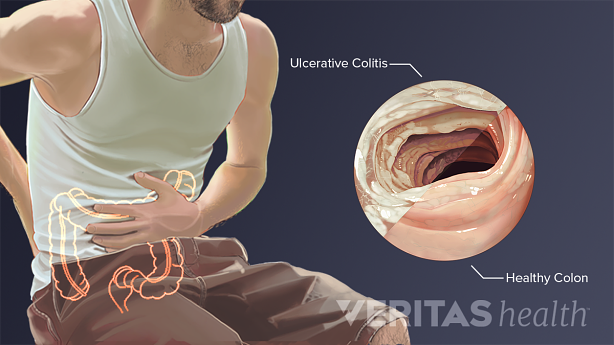 Medical illustration of ulcerative colitis