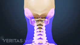 Vista posterior que resalta el área de la columna cervical que puede causar dolor de cuello y brazo.