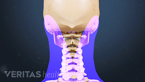 Posterior view highlighting area of the cervical spine that can cause neck and arm pain