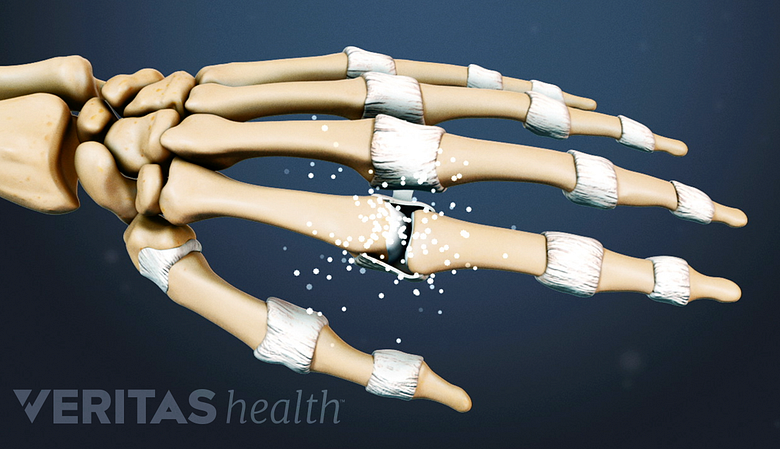 Arthritis and Grip: How Arthritis Affects Grip, How to Strengthen Grip
