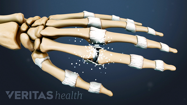 Hand bones showing rheumatoid arthritis