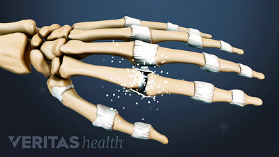 Illustrated skeleton hand showing rhematoid arthritis in the joints