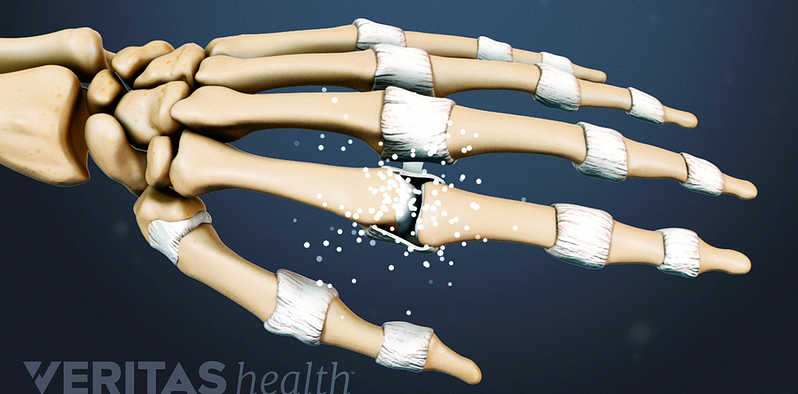 Illustrated skeleton hand showing rhematoid arthritis in the joints