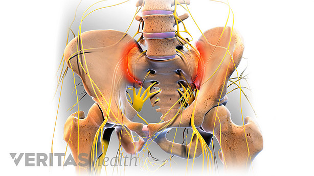 Anterior view of pain in the SI Joint