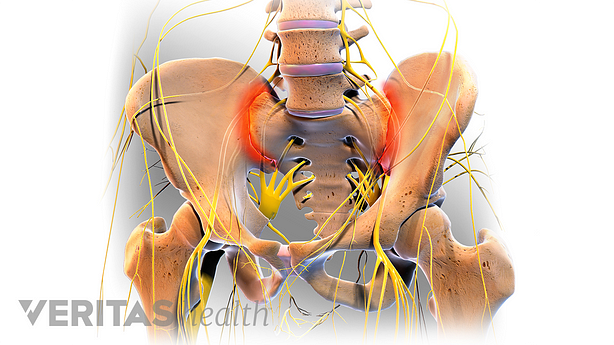Anterior view of the pelvis highlighting sacroiliitis