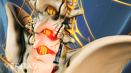 Medical illustration showing radiofrequency neurotomy in the lumbar spine