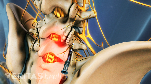 Medical illustration showing radiofrequency neurotomy in the lumbar spine