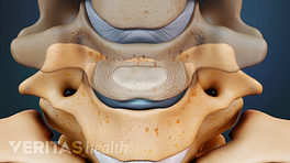Medical illustration of cervical vertebrae and discs. The middle vertebrae is transparent so you can see the disc between the vertebrae