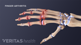 Medical illustration of hand with arthritis