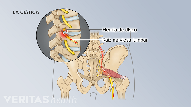 Una hernia de disco que presiona la raíz del nervio lumbar y causa dolor de ciática.