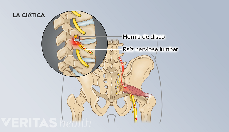 Hernia de disco lumbar presionando una raíz nerviosa espinal, causando ciática.