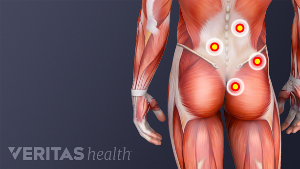 An illustration showing trigger points in the lower back.